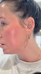 Here are some of my symptoms, trying to make a list for my doctor. Aching  all over random pains random places I can touch a balloon all day but a  bandaid leaves