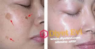 Gunes Lekesi Ve Cilt Lekeleri Icin Dogal Maskeler Gunes Lekesi Ve Cilt Lekeleri Icin Dogal Maskeler Bulacaginiz Harika Bi Skin Care Mask Beauty Hacks Skin Care