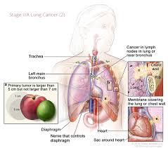 There are also a number of medicines known as targeted therapies. Lung Cancer Staging Rocky Mountain Cancer Centers