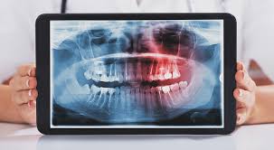 Other ways to reduce wisdom teeth swelling include cold compresses, ice chips, or ice. Wisdom Teeth Pictures Symptoms Surgery Pain Relief Ask The Dentist