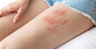 Image result for shingles