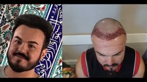 Die haare wachsen dann wahrscheinlich von alleine wieder nach. Haartransplantation Vorher Nachher Elithairtransplant Istanbul