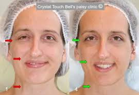 Crystal Touch Bell's Palsy Clinic