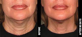 Radiofrequency with microneedling is a noninvasive procedure that treats wrinkles and loose skin. A Non Invasive Skin Tightening Lifting Treatment Ultherapy