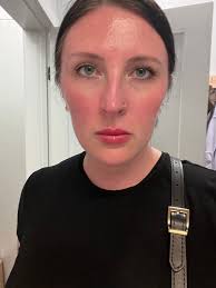 Anyone else dealing with severe head pressure (squeezing) with whooshing  air and heartbeat sound? Ears and head feel clogged too. I get like a head  rush and a off balance dizzy feeling