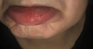 In diesem artikel erfahren sie mehr über die ursachen und behandlungen von inneren schwingungen. Ich Beisse Mit Absicht In Mein Inneres Lippenfleisch Gesundheit Und Medizin Psychologie