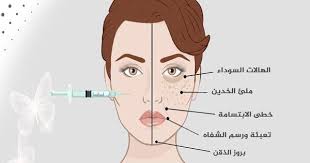 اماكن حقن الفيلر الهالات السوداء لتعبئه و ملئ الخدين لخطى الابتسامة لتعبئه و رسم الشفاه لبروز الذقن لحقن تكسا Omc Movie Posters Movies