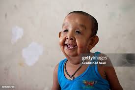 206 Progeria Stock Photos, High-Res Pictures, and Images