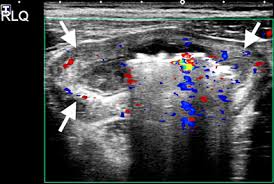 Image result for Neutropenic Colitis