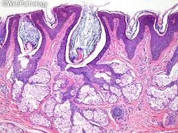 Nevus sebaceus or sebaceous nevus (the first term is its latin name, the second term is its name in english; Webpathology Com A Collection Of Surgical Pathology Images
