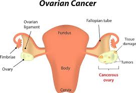 The ovaries are the female reproductive organs in which the this guide focuses exclusively on epithelial ovarian cancer. Ovarian Cancer Treatment Bangalore Gynecological Cancer