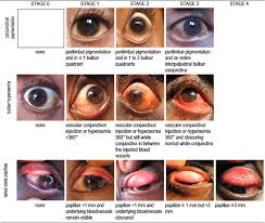 Image result for Vernal Conjunctivitis