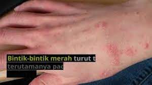 Terdapat ubat sapu yang boleh digunakan untuk merawat kudis buta ini. Kudis Scabies Penyebab Dan Rawatan Penyakit Kudis Doctoroncall