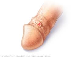 These sores are usually (but not always) firm, round, and painless. Syphilis Symptoms And Causes Mayo Clinic