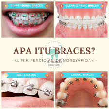 زولفضلي زين on twitter pagi ni nak share pasal braces lah sikit buat yang ada terfikir fikir nak pakai braces tapi tak tau apa kena bayar apa kena buat dan. Facebook