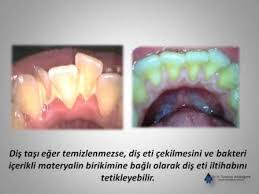 Evde yapacağınız bir kaç yöntemle diş taşlarınızın temizlenmesine yardımcı olabilirsiniz. Dis Tasi Temizligi Dr Tuncay Akdoganli Dis Eti Hastaliklari Uzmani
