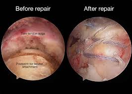 Image result for Rotator Cuff Triad Test
