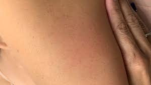 It's the rash that appears after vaccination and not the arm. Moderna Vaccine Causing Covid Arm Among Some Patients Kmph