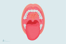 Image result for Physical injury red spots roof of mouth