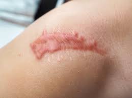 In most cases, corticosteroid injections alone will not permanently remove the keloid. Hypertrophic And Keloid Scarring Lazaderm Free Consult