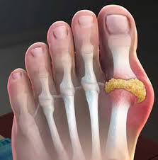 Image result for gout symptoms toe