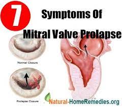 Pin By Tamara Wall On Nurse Mnemonics Acronyms And Flash Cards Mitral Valve Mitral Valve Prolapse Mitral Valve Regurgitation