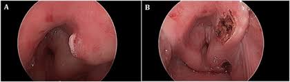 Merkel cell carcinoma (mcc) commonly appears as a painless mass on or just under the skin surface. Seed And Soil Pharyngeal Merkel Cell Carcinoma After Radiotherapy For Laryngeal Squamous Cell Carcinoma Sciencedirect