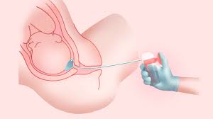 Image result for Labor Induction