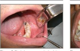 At least one sentinel node was 8.7.3 accuracy of sentinel node biopsy. Oral Soft Tissue Biopsy An Overview Semantic Scholar