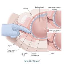 During early labor, the cervix dilates to 3 cm. Membrane Sweep One Way To Get Your Labor Started Babycenter