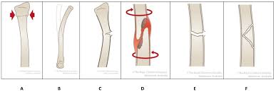 Image result for Fractures in Children