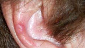 Chondrodermatitis Nodularis Helicis Symptoms And More