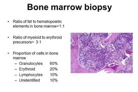 Myeloid To Erythroid Ratio Normal Is 3 1 Hematology Pathology Bone Marrow