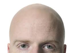 Appearance of hair loss in case of females is absolutely different from its appearance in case of men. How To Regrow Hair Naturally In Bald Area Hair Transplant Dubai