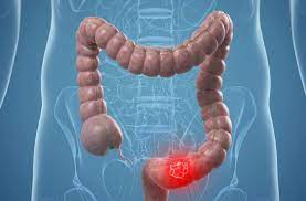 Stomach Bloating How To Relieve Your Tight Round Belly U S News