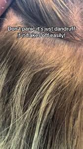 Image result for lice vs dandruff