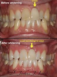 The costs of zoom whitening varies from dentist to dentist. Zoom Whitening Burlington Smiles Dental