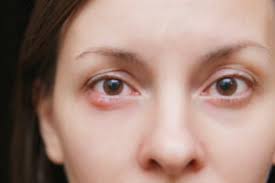 Milia or milium (singular) are small, white bumps/cysts that typically appear on the eyelids, nose milia can occur in all age groups, but are most common in newborns and commonly confused with neonatal acne. Bumps Under The Eyes Types How To Treat Them Nvision Eye Centers