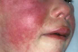 Image result for Scarlet Fever