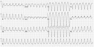 The ectopic beat is constant, and the qrs wave on ecg will be abnormal but consistent. 12 Lead Ecg Of A Ventricular Tachycardia Vt In An Arrhythmogenic Download Scientific Diagram
