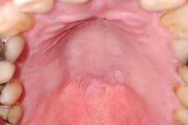 Image result for papillomavirus tongue)