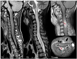 Image result for Myelitis
