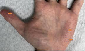 Your kidney doesn't get enough blood to filter. Cureus Rare Etiology Of Renal Failure In A 25 Year Old Caucasian Man Fabry Disease With A Novel Mutation Of Gla Gene
