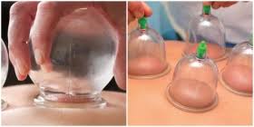 La ventouse humide (hijama) est l'un des remèdes de la sunnah du prophète muhammad (sallallahu alaihi wasallam). Tous Les Articles Objectif Sante