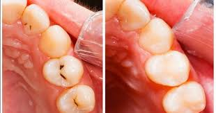 5 Consejos Para Prevenir Y Tratar Las Caries Curar Las Caries Caries Remedio Para El Dolor De Dientes
