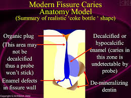 Cavity detector liquids only stain the outer infected dentin and do not stain uninfected areas. Powerpoint Instructions To Advance To The Next Slide Bullet Point Or Image Simply Click The Left Mouse Button Ensure The Arrow Is Not On An Icon If Ppt Download