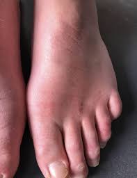 My feet and hands are very itchy. Is My Skin Rash A Covid 19 Symptom