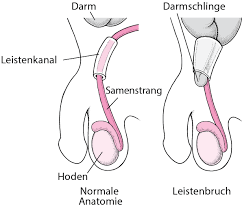 Figure Was Ist Eine Leistenhernie Msd Manual Ausgabe Fur Patienten