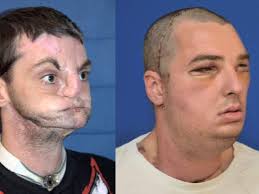 Face Donor's Sister Meets Recipient