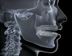 Dentists might recommend mouth guards for their patients who grind their teeth at night, play contact sports, or have tmj problems or sleep disorders. How To Mold A Mouth Guard Denta Gard Mouthguards